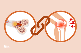 joint-pain-bone-loss-fracture-risk